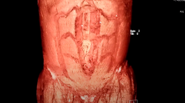 TAC CON SUSTRACCION DIGITAL HERNIA INCISIONAL