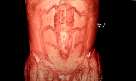 TAC CON SUSTRACCION DIGITAL HERNIA INCISIONAL