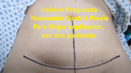 HERNIOPLASTIA INCISIONAL DE STOPPA