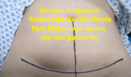 HERNIOPLASTIA INCISIONAL DE STOPPA