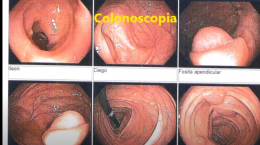 Mucocele Apendicular