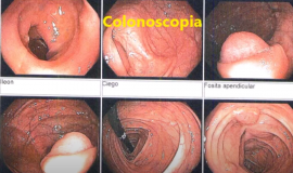 Mucocele Apendicular