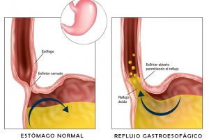 Reflujo Gastroesofagico