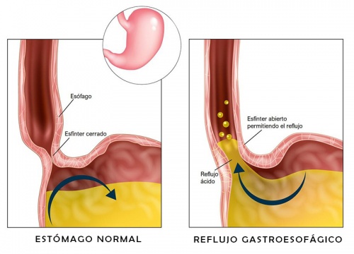 Reflujo Gastroesofagico