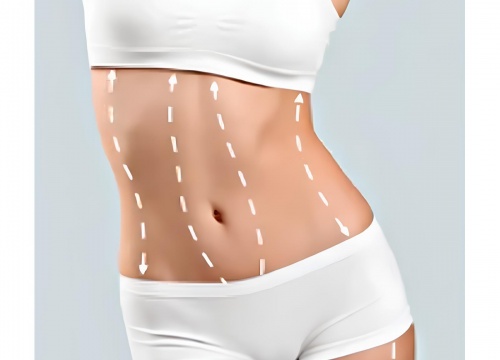 Abdominoplastia con Liposucción