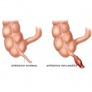 Apendicitis Aguda