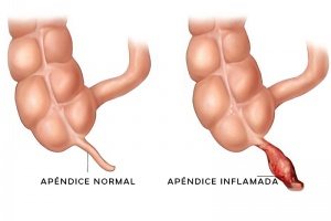 Apendicitis Aguda