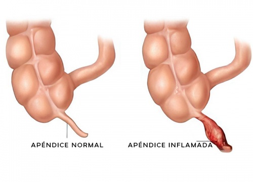 Apendicitis Aguda