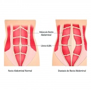 Diástasis de los Rectos