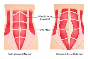 Diástasis de los Rectos