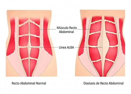 Diástasis de los Rectos