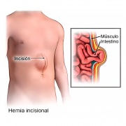 Hernia Incisional