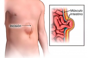 Hernia Incisional