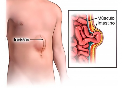 Hernia Incisional