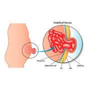 Hernia Umbilical