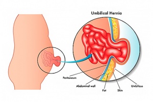 Hernia Umbilical