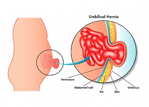 Hernia Umbilical