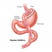 By-Pass Gástrico