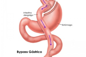 By-Pass Gástrico