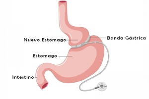 Banda Gástrica