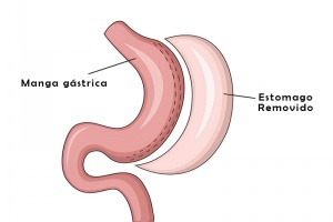 Manga Gástrica