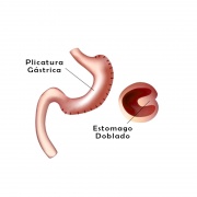 Plicatura Gástrica