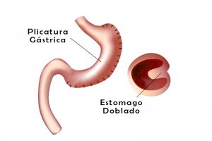 Plicatura Gástrica