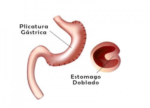 Plicatura Gástrica