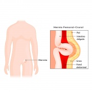 Hernia Femoral-Crural