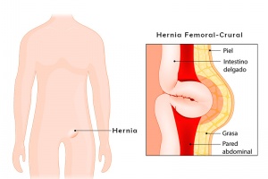 Hernia Femoral-Crural