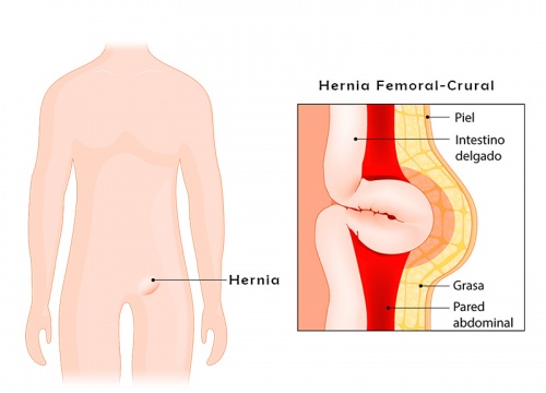 Hernia Femoral-Crural