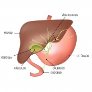 Colelitiasis