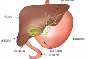 Colelitiasis