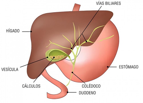 Colelitiasis