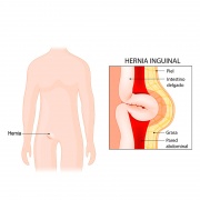 Hernia Inguinal