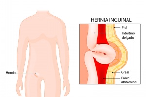 Hernia Inguinal