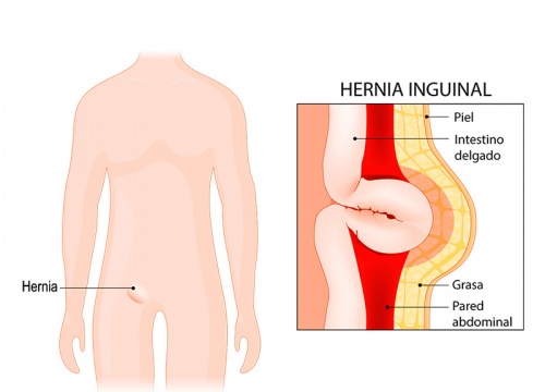 Hernia Inguinal