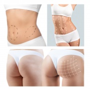 Abdominoplastia con Liposucción e Inyección