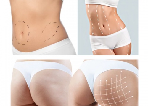 Abdominoplastia con Liposucción e Inyección